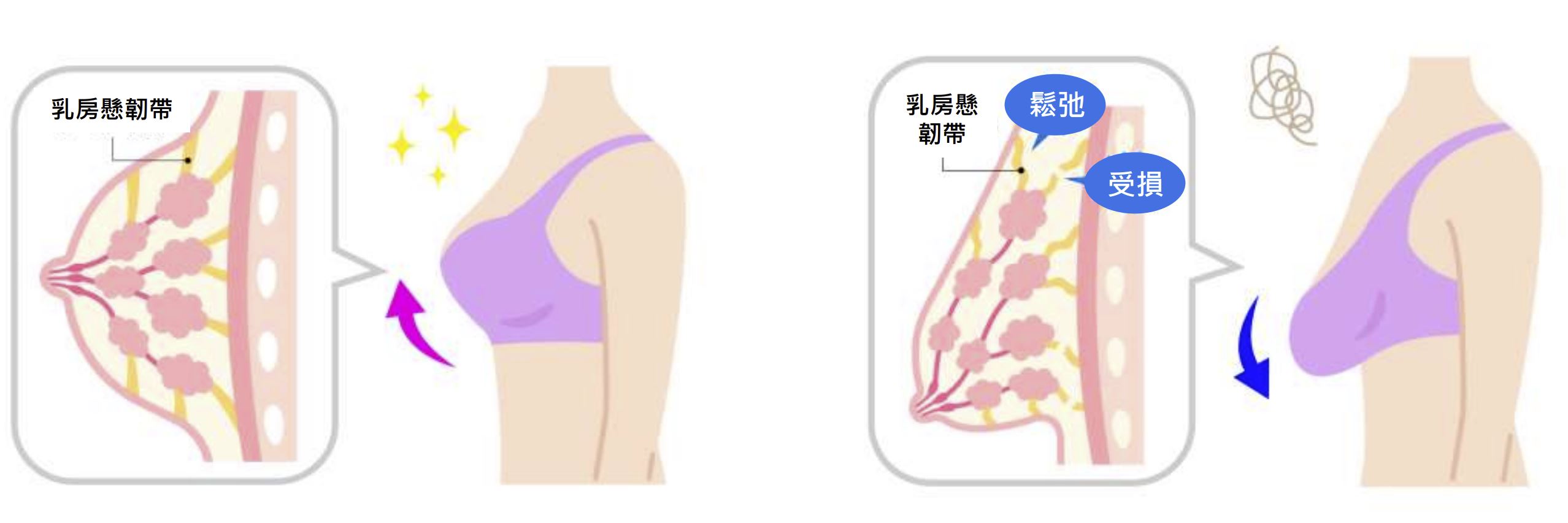 乳房懸韌帶圖示.JPG