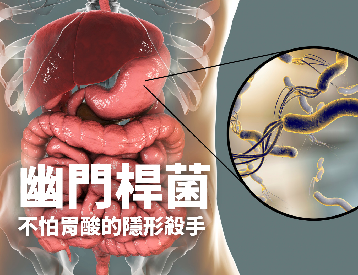 幽門桿菌示意圖