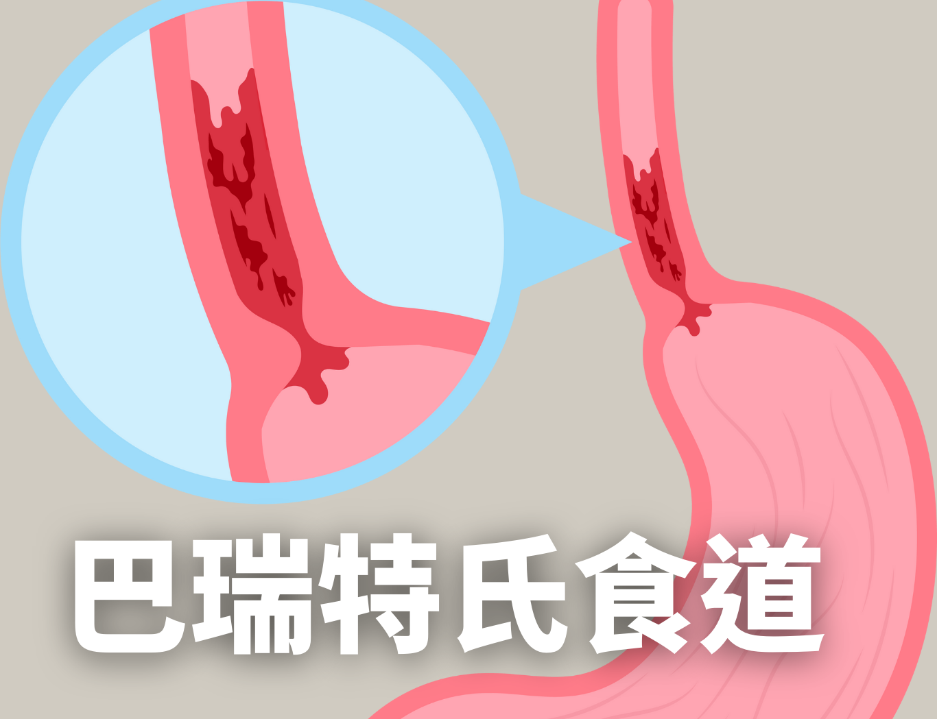 食道病變示意圖