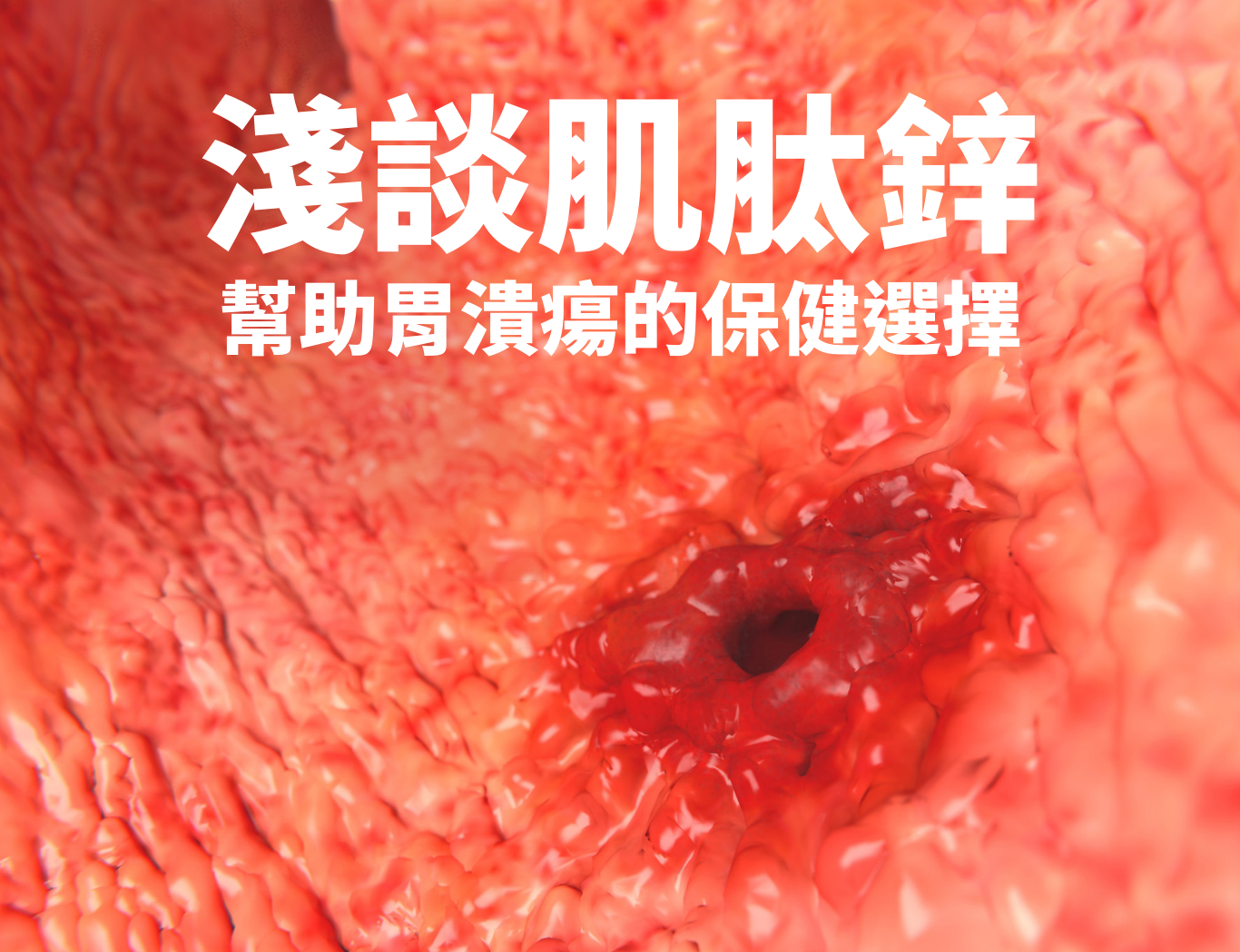 胃潰瘍與保護圖示