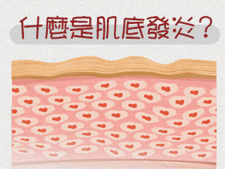 什麼是肌底發炎