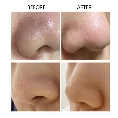 Milk Touch黑頭粉刺清除泥棒6