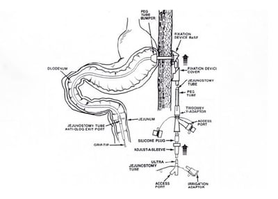 Jejunal Feeding Tubes with ENFit™ Connector (J thru G)3