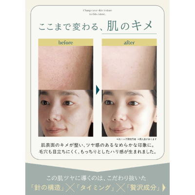 【 NOWL 】20萬本塗抹式微針雙效精華3