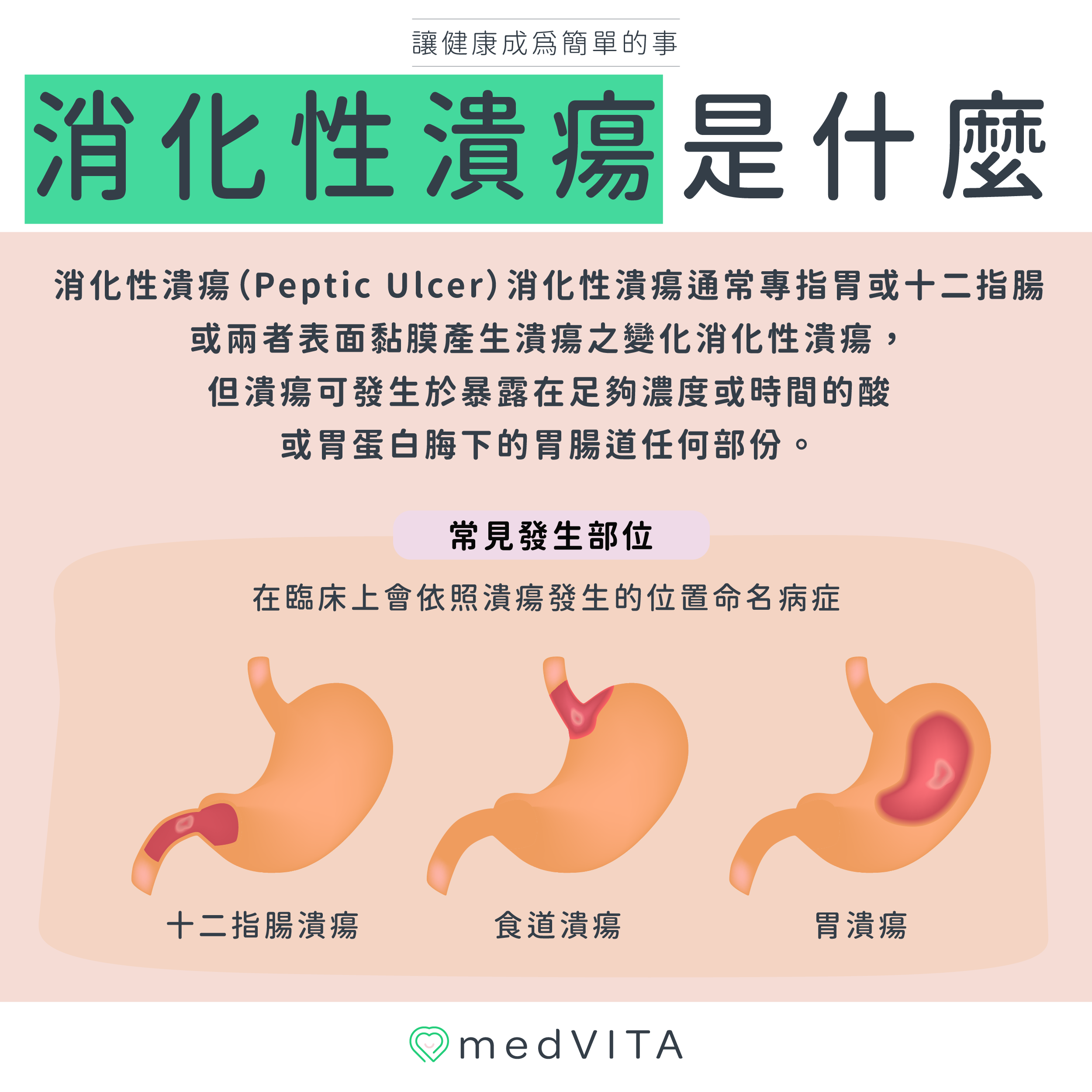 覺㦡medVITA | 消化性潰瘍是什麼