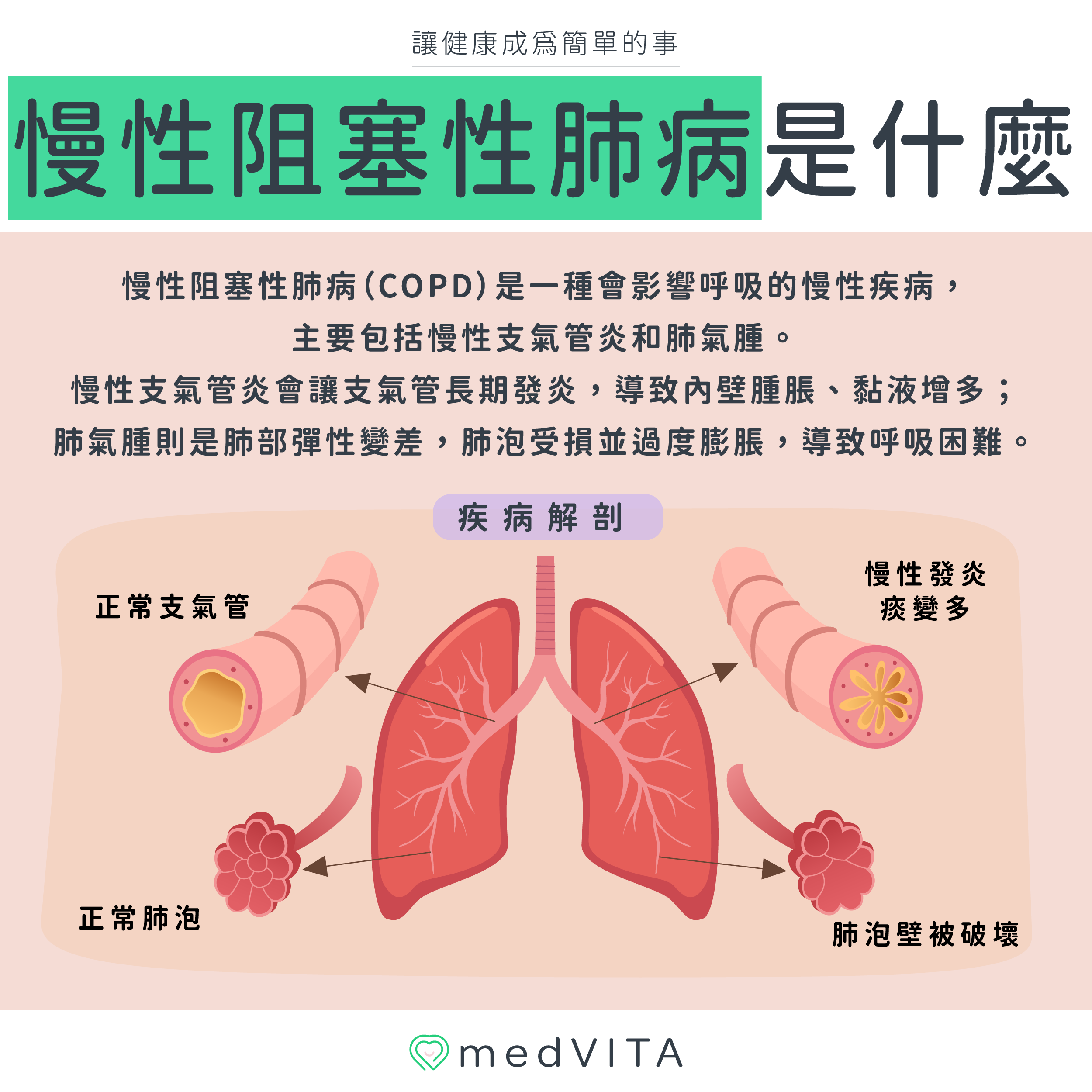 覺㦡medVITA | 慢性阻塞性肺病是什麼