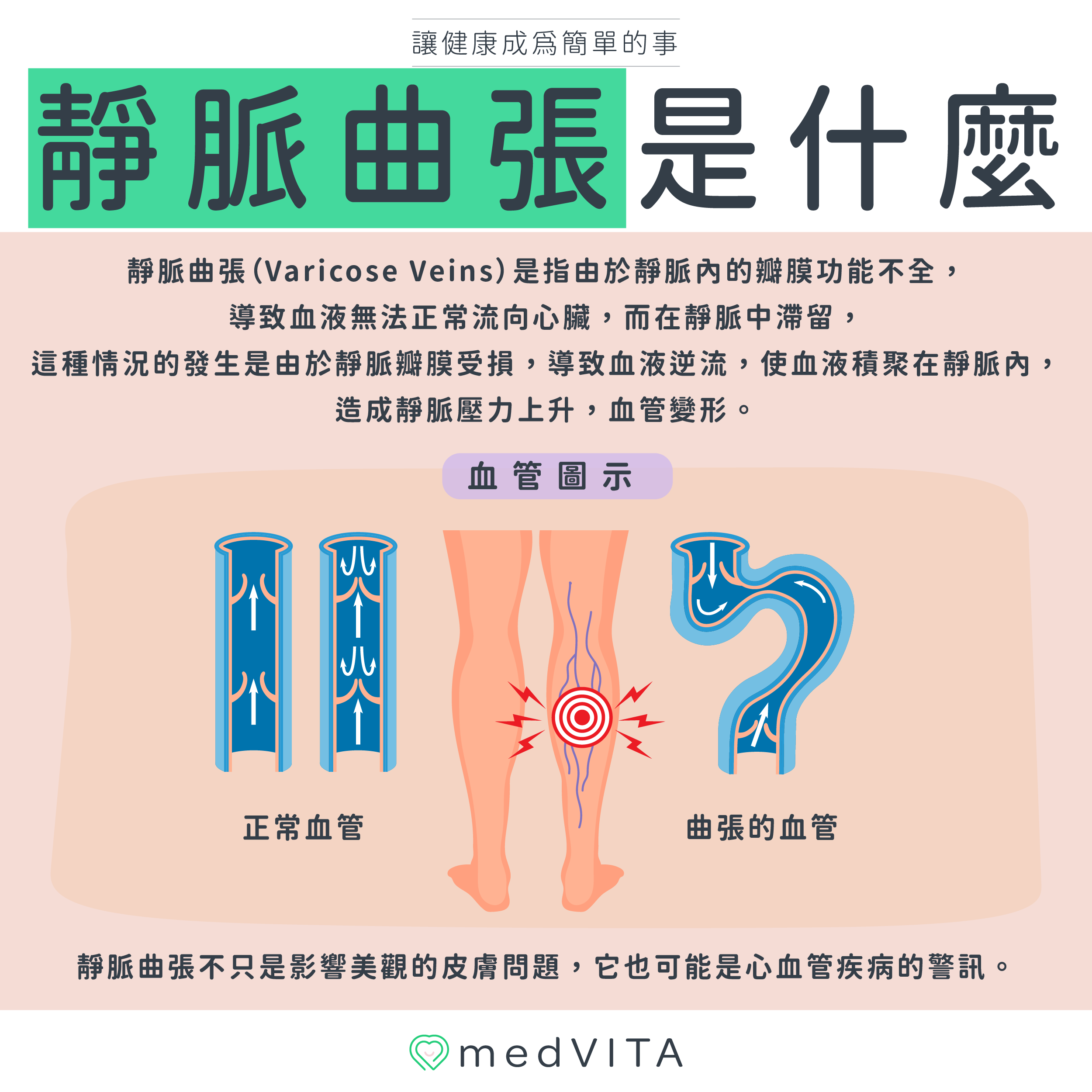 覺㦡medVITA | 靜脈曲張是什麼