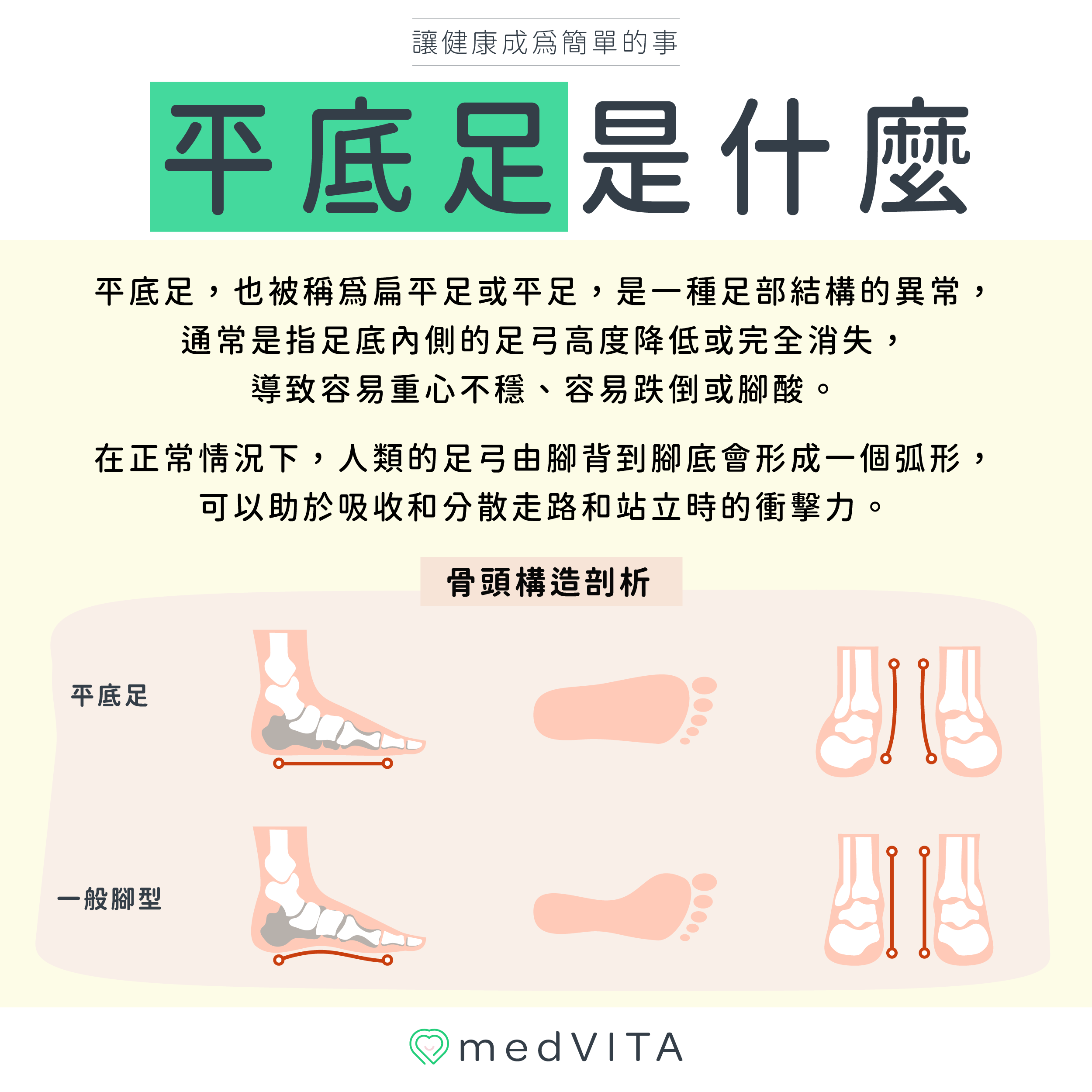 覺㦡medVITA | 平底足是什麼