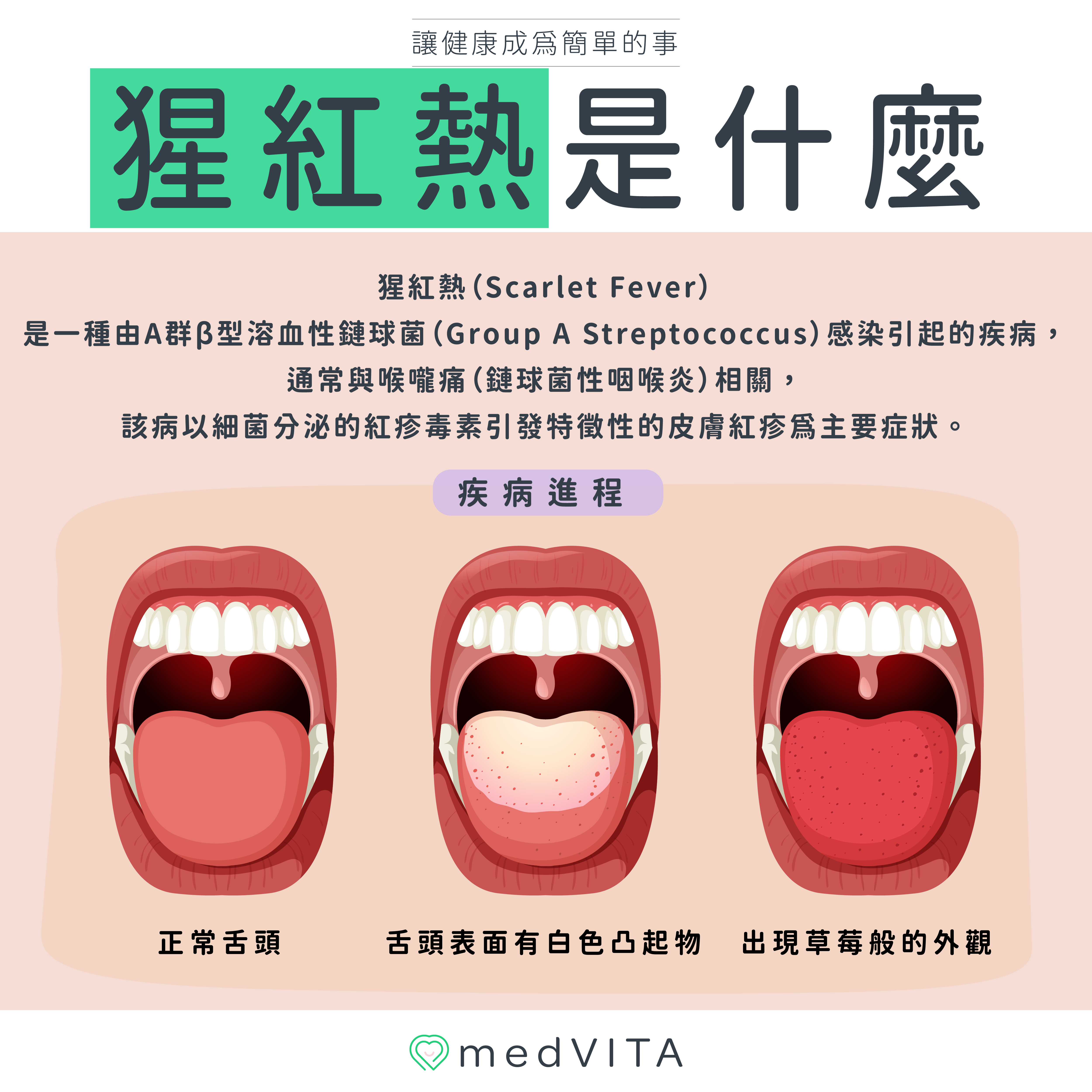 覺㦡medVITA | 猩紅熱是什麼
