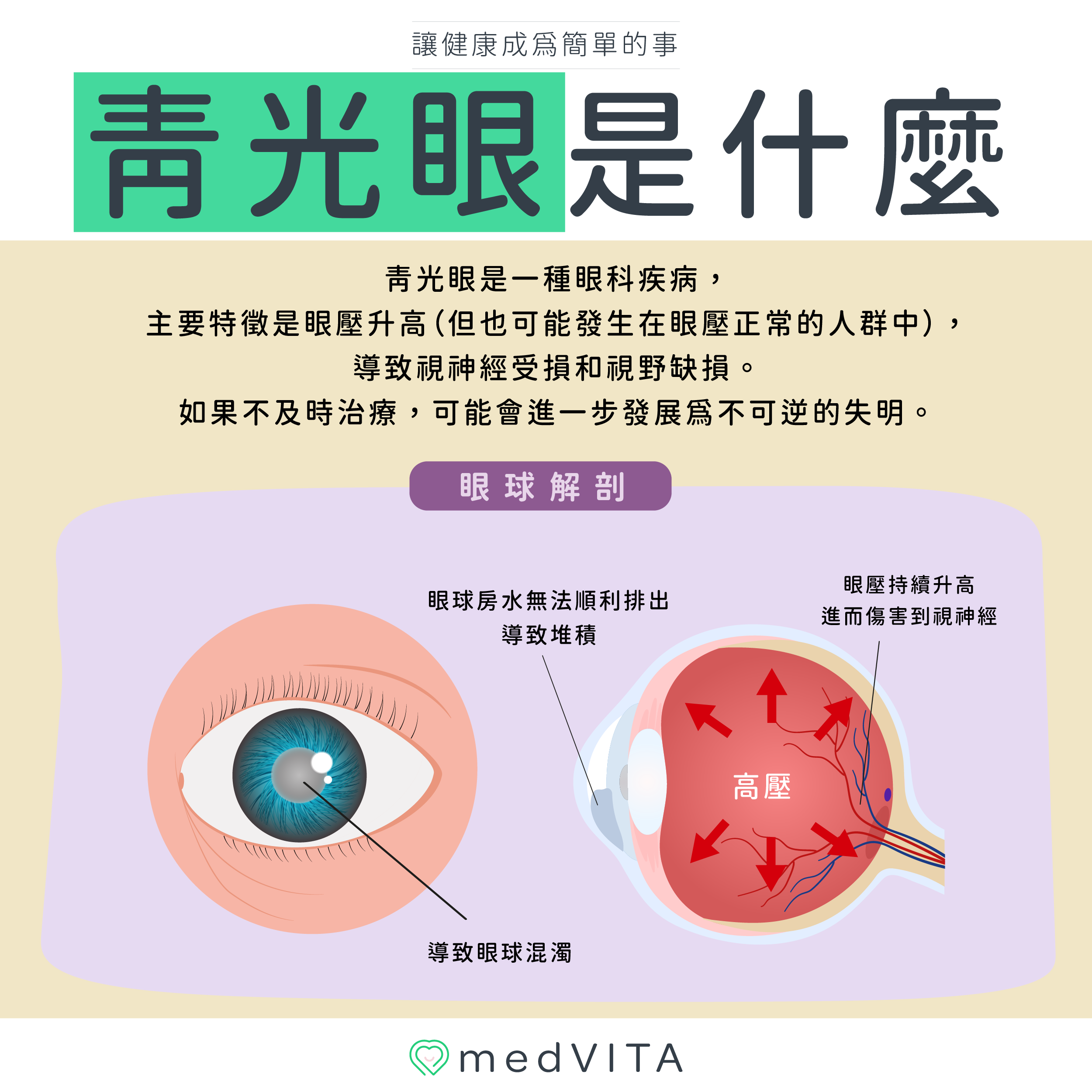 覺㦡medVITA | 青光眼是什麼
