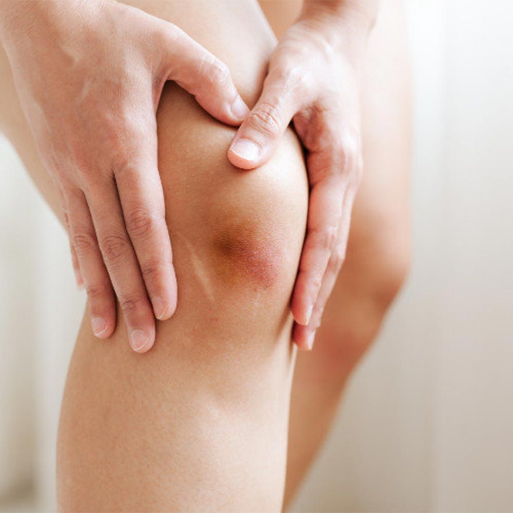 黑青瘀血怎麼辦？ 教您處理方法與何時需要看醫生！