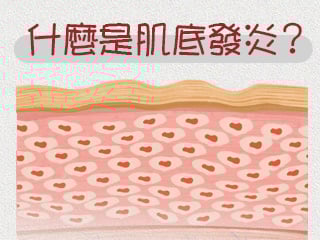 什麼是肌底發炎