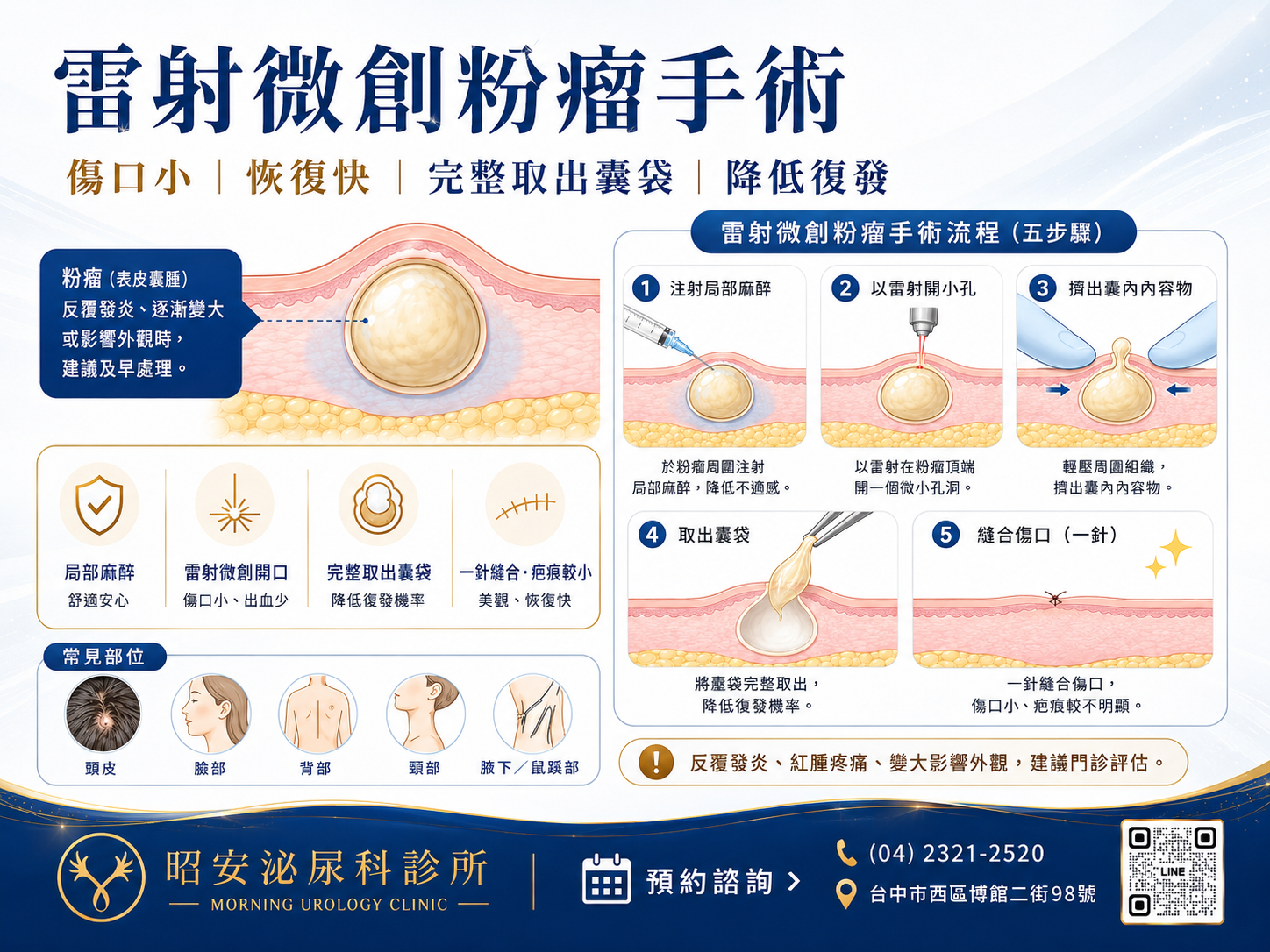 粉瘤越擠越大顆？泌尿科醫師：雷射微創完整取出「囊袋」才是防復發關鍵！
