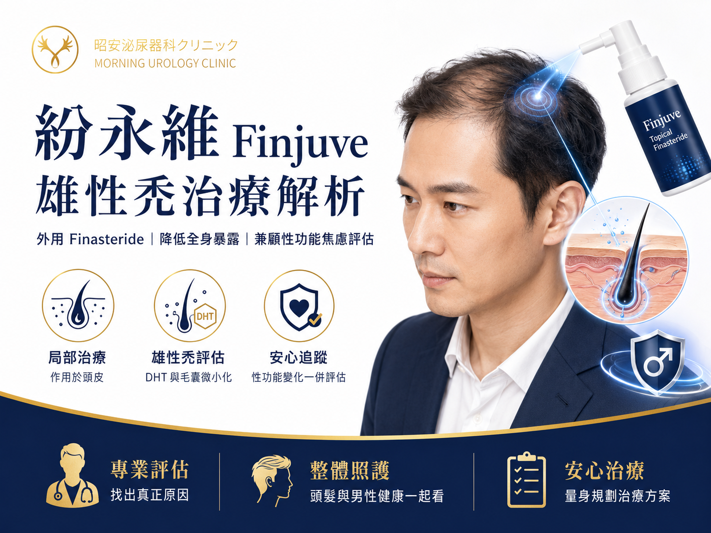 怕口服生髮藥影響性功能？外用 Finasteride 治療雄性禿效果與副作用解析