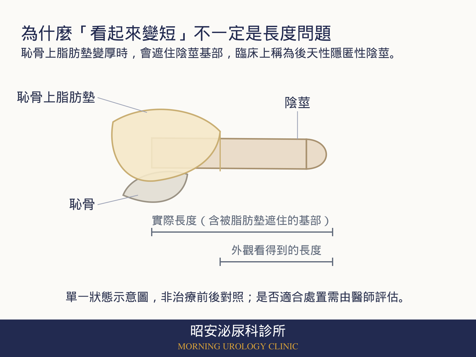 側面線稿示意圖:恥骨上方的黃色脂肪層覆蓋住陰莖基部,灰色為恥骨,膚色柱體為陰莖。下方兩條量測線,上面較長的一條標示含被脂肪遮住基部的實際長度,下面較短的一條標示從外觀看得到的長度。