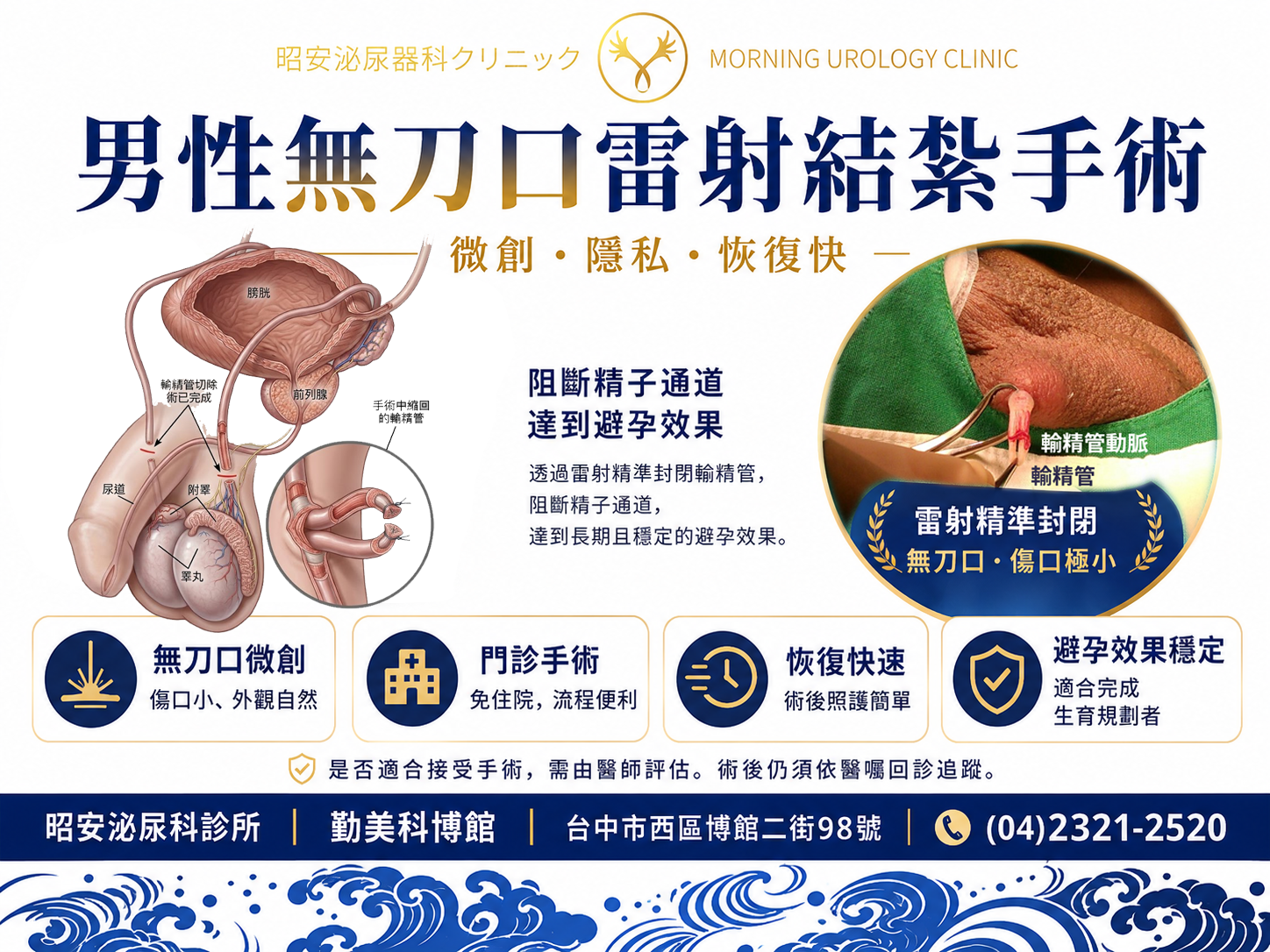 台中男性無刀口雷射結紮手術