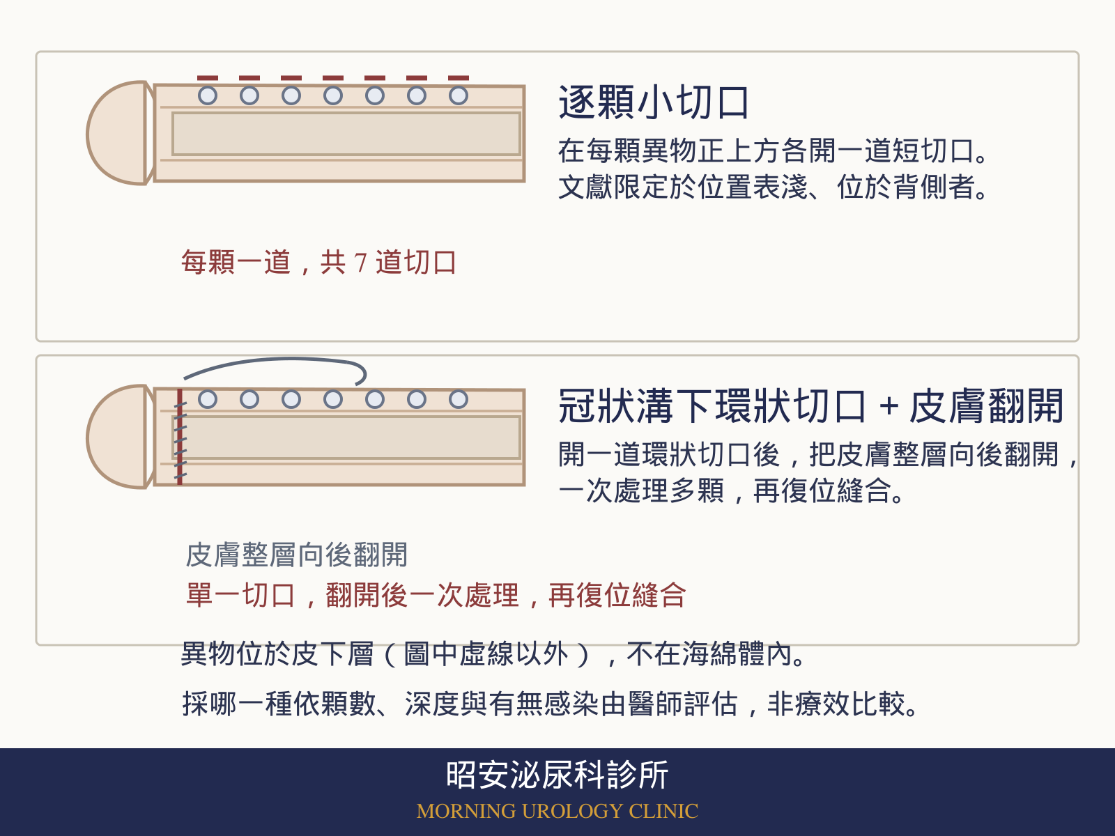 入珠取出切口方式示意圖:上格為陰莖側面線稿,背側畫有數顆皮下異物,每顆異物正上方各有一道短切口;下格為冠狀溝下的一道環狀切口,皮膚整層向後翻開後一次處理,再復位縫合。