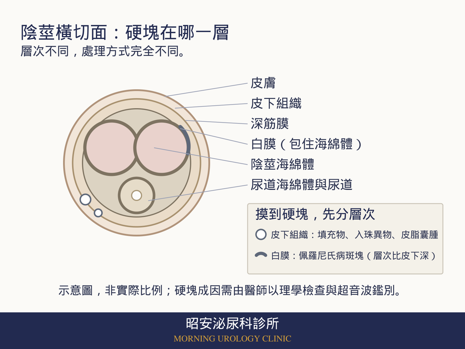 陰莖橫切面示意圖,由外而內標示皮膚、皮下組織、深筋膜、包住海綿體的白膜、陰莖海綿體,以及腹側的尿道海綿體與尿道;圖中在皮下組織層畫出兩個小圓形硬塊,在白膜上畫出一段弧形斑塊,用來對照硬塊可能所在的層次。