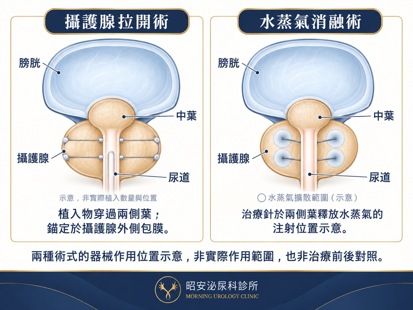 攝護腺兩種微創術式的器械位置示意圖,左右兩格對照。左格「攝護腺拉開術」:兩條兩端帶小錨釘的植入物由尿道橫向穿過左右兩側葉,錨定於攝護腺外側包膜。右格「水蒸氣消融術」:四支治療針自尿道側伸入左右兩側葉,針端各有一個淡藍色圓形,標示水蒸氣擴散範圍。兩格皆標註膀胱、中葉、攝護腺與尿道的位置。