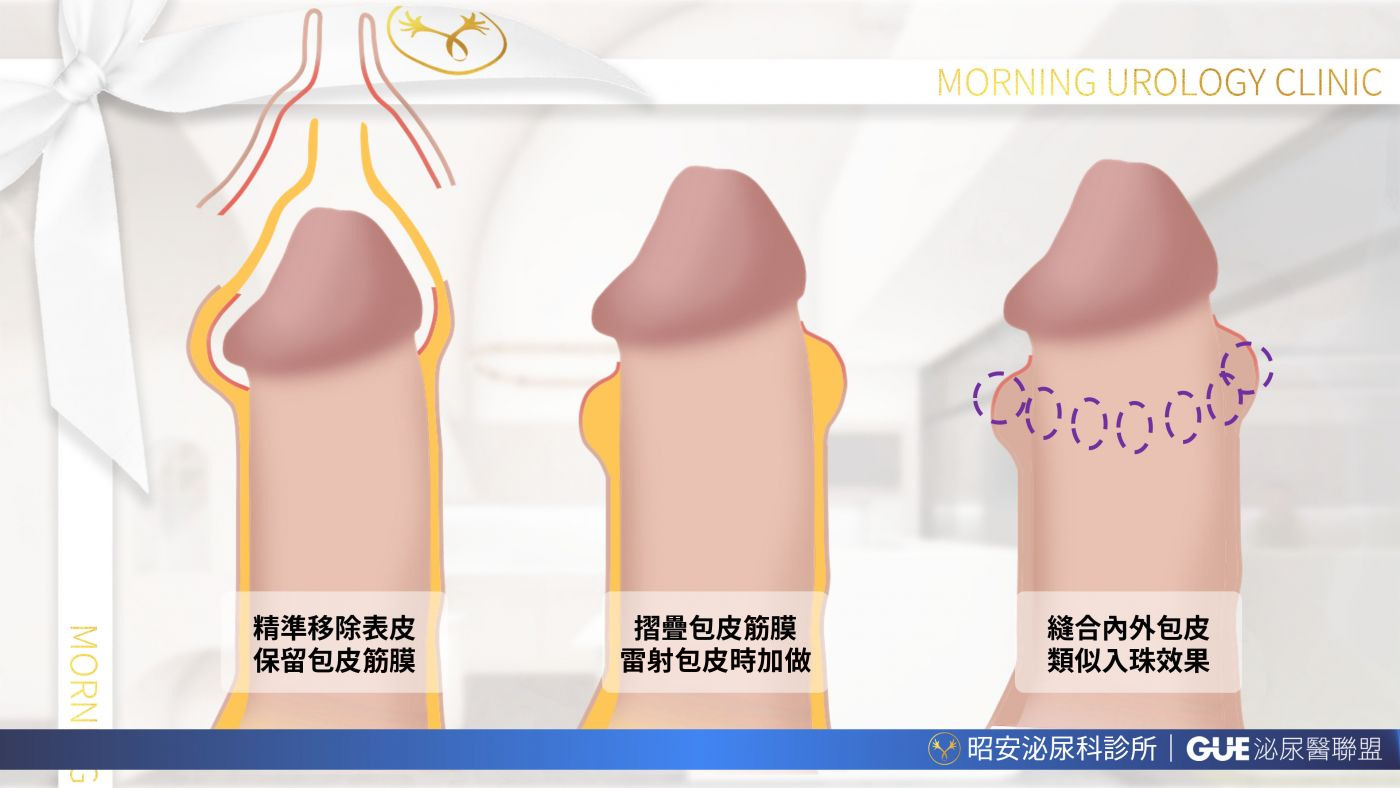 包皮筋膜摺疊術三階段示意圖：第一步精準移除表皮並保留包皮筋膜，第二步將包皮筋膜摺疊，第三步縫合內外包皮。