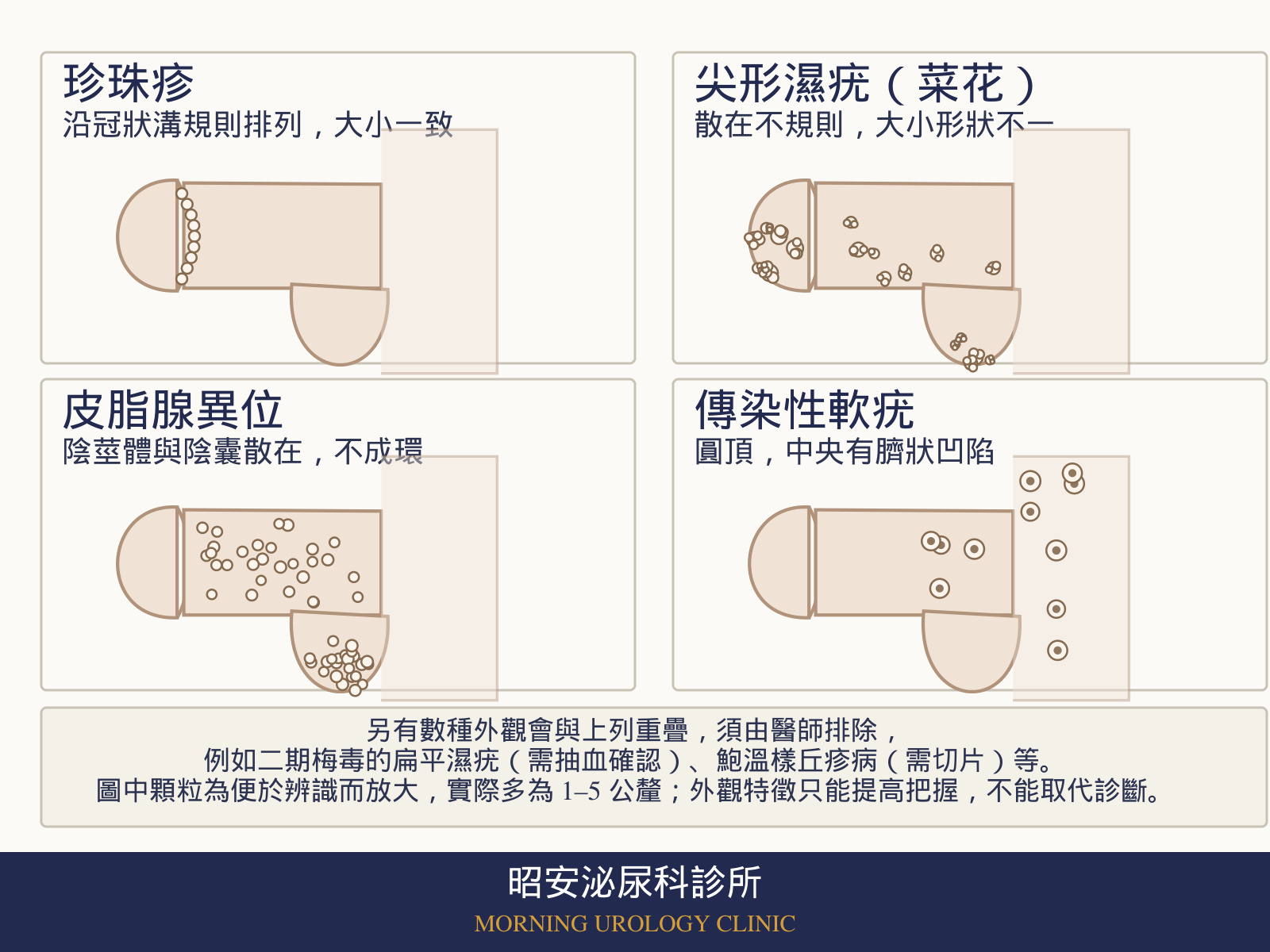 四宮格醫學示意圖,以陰莖側面線稿比較四種小顆粒的分布與外觀:珍珠疹沿冠狀溝規則排成一圈、大小一致;尖形濕疣(菜花)散在不規則、大小與形狀不一;皮脂腺異位散布在陰莖體與陰囊、不成環;傳染性軟疣呈圓頂、中央有臍狀凹陷。
