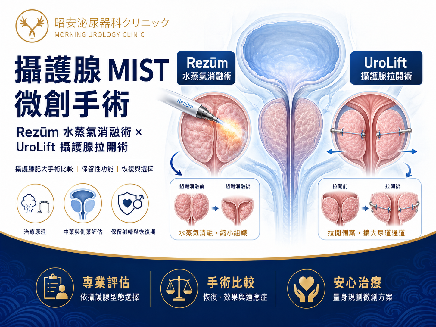 台中攝護腺肥大微創手術與治療評估
