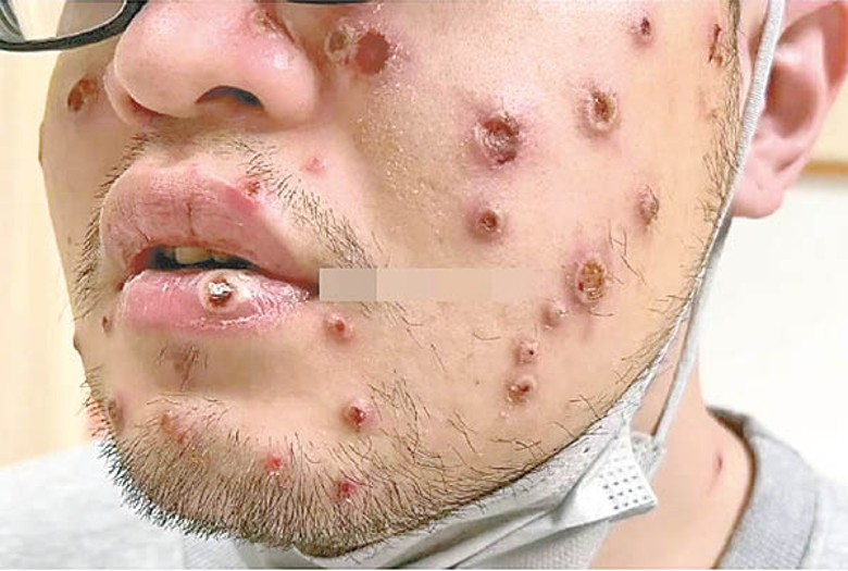 公費猴痘疫苗(mPOX)-昭安泌尿科每日夜診便利接種 昭安泌尿科診所發布的公費猴痘 / mPOX 疫苗接種宣傳海報。主打每日夜診提供接種服務,方便上班族下班後前往。海報標示三大特點:公費接種、完成2劑保護更完整、依醫師評估安排。呼籲大眾保護自己,也保護親密伴侶。實際接種資格與安排依現場評估與公費規定為準。