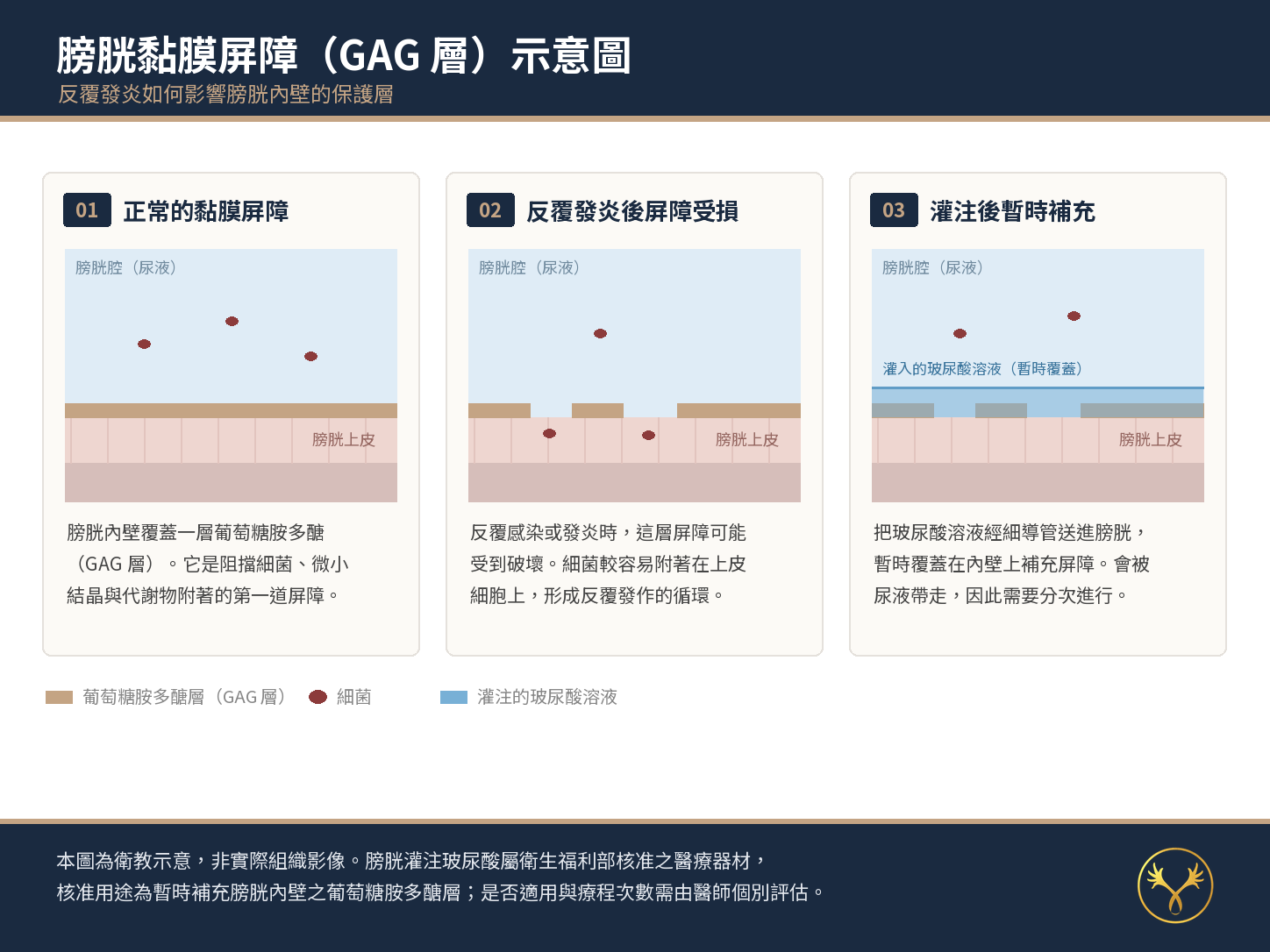 膀胱黏膜屏障(GAG 層)示意圖 膀胱黏膜屏障(GAG 層)示意圖:三格對照正常的黏膜屏障、反覆發炎後屏障受損,以及膀胱灌注玻尿酸後暫時覆蓋補充的狀態。為衛教示意圖,非實際組織影像;是否適用與療程次數需由醫師個別評估。